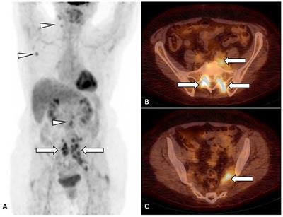 Case Report: Skeletal Muscle Lymphoma as a Result of Slow Centrifugal Migration of Untreated Primary Neurolymphomatosis?